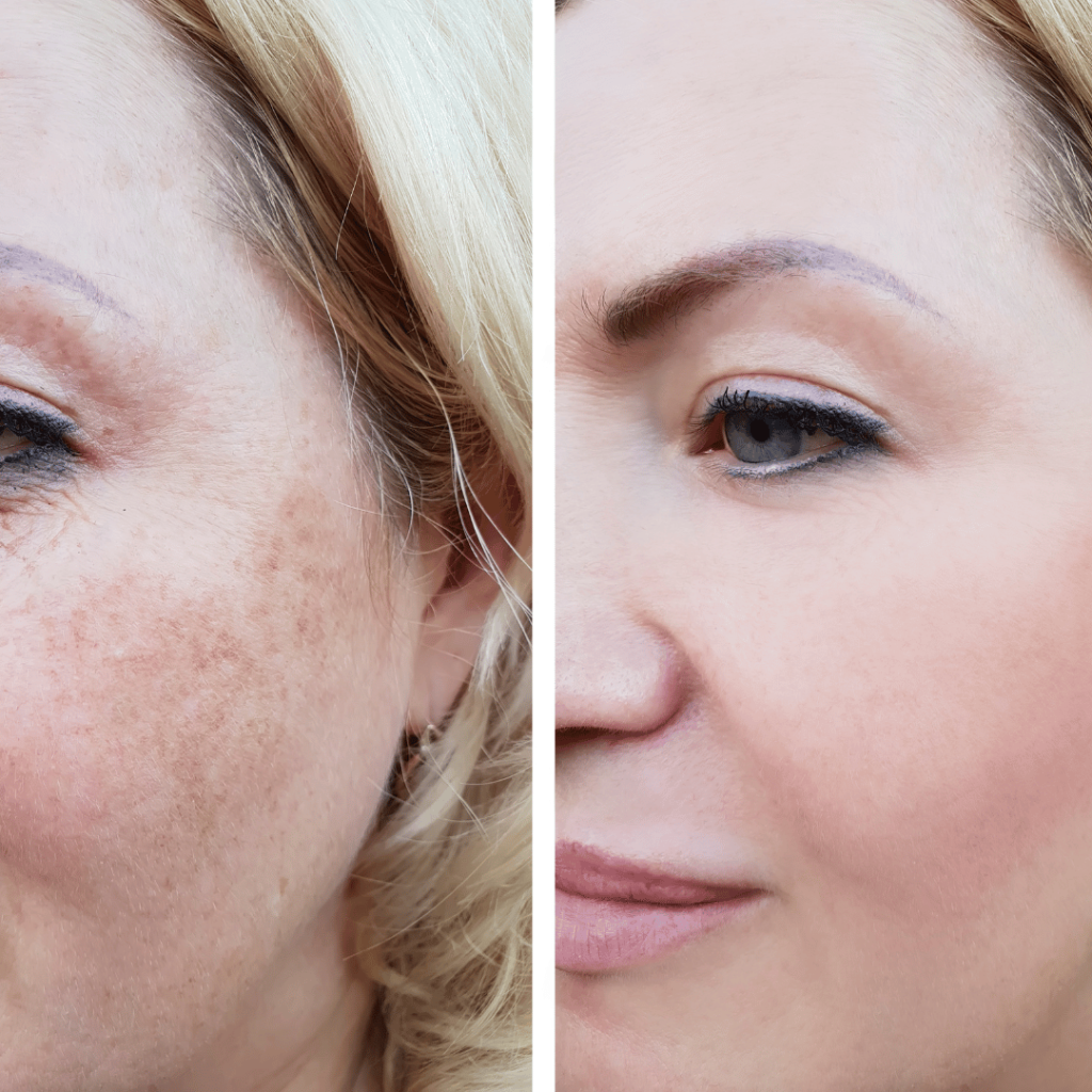 Dark Spot Removal in Glendale CA