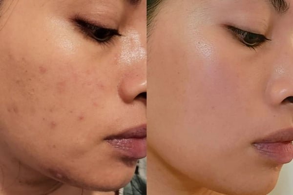 Age spot removal Glendale California