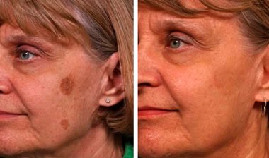 Age spot removal before and after Glendale