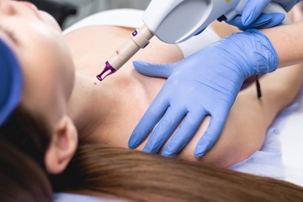 Birthmark removal Glendale CA