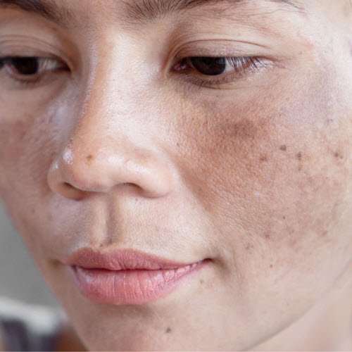 brown spot removal in Glendale CA