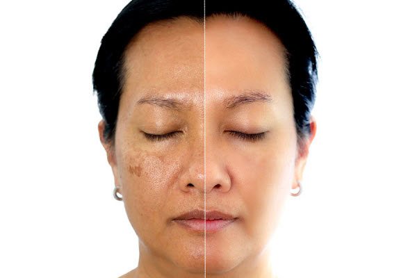 dark spots removal Glendale