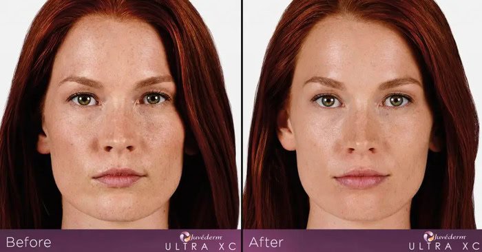 JUVEDERM Glendale CA