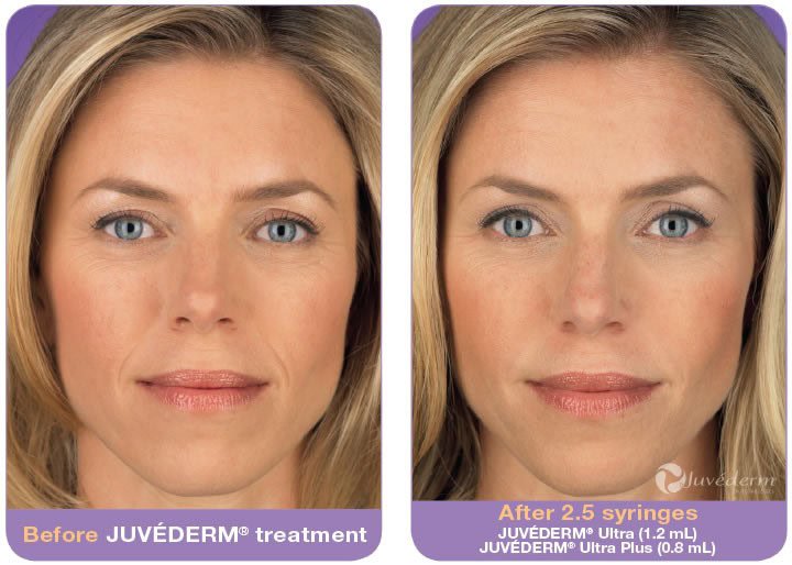 JUVEDERM in Glendale-CA