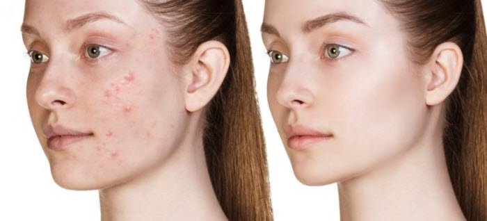 Acne Facial Glendale CA