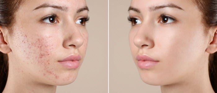 Acne facial Glendale