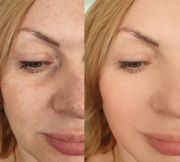 Before and after pigmentation spot removal results