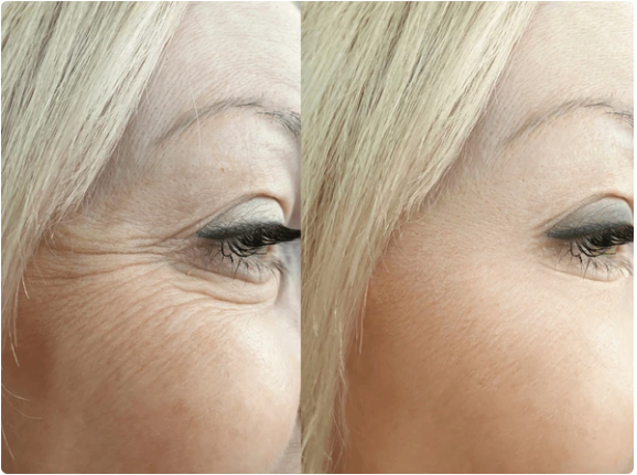 Botox La Canada