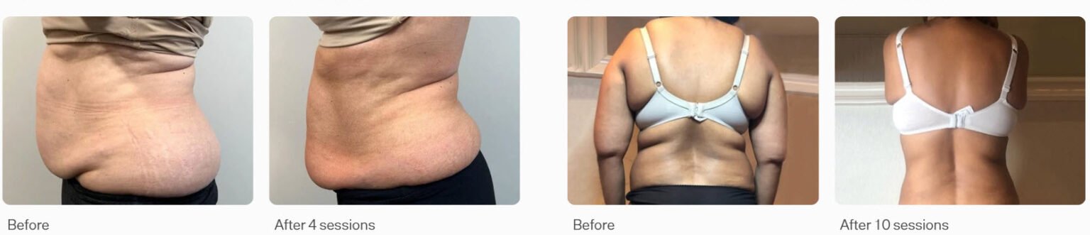 T-Shape-2-Before-and-After-Los-Angeles-CA