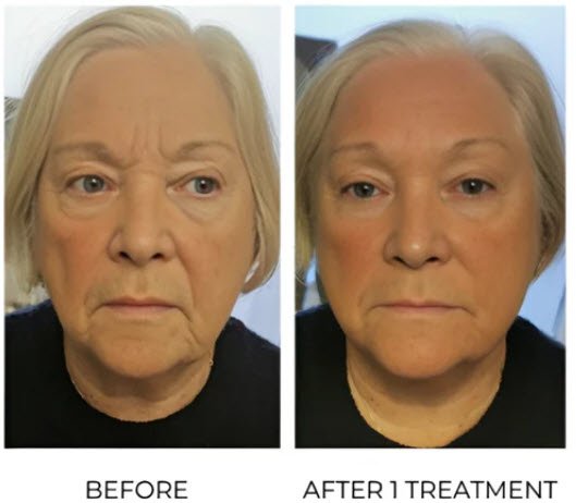 T-Shape-2-Before-and-after-face