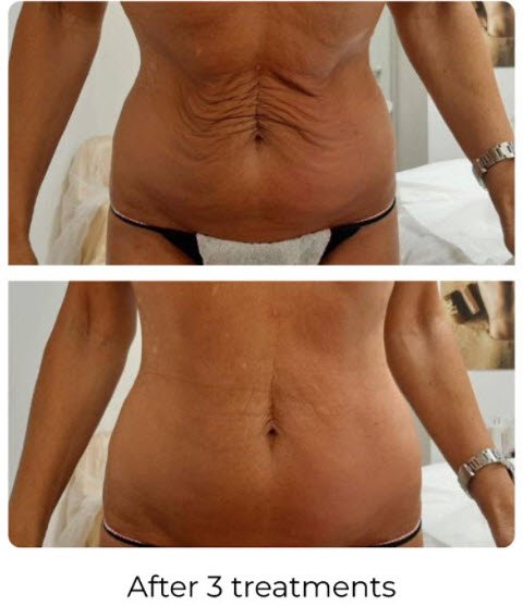 T-shape-2-before-after-belly