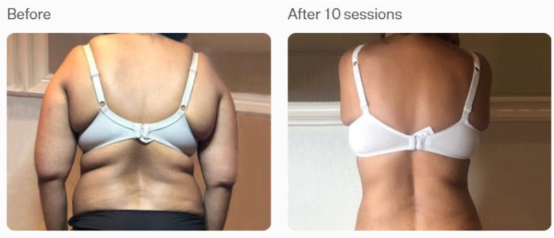 T-shape-2-midsection-before-and-after
