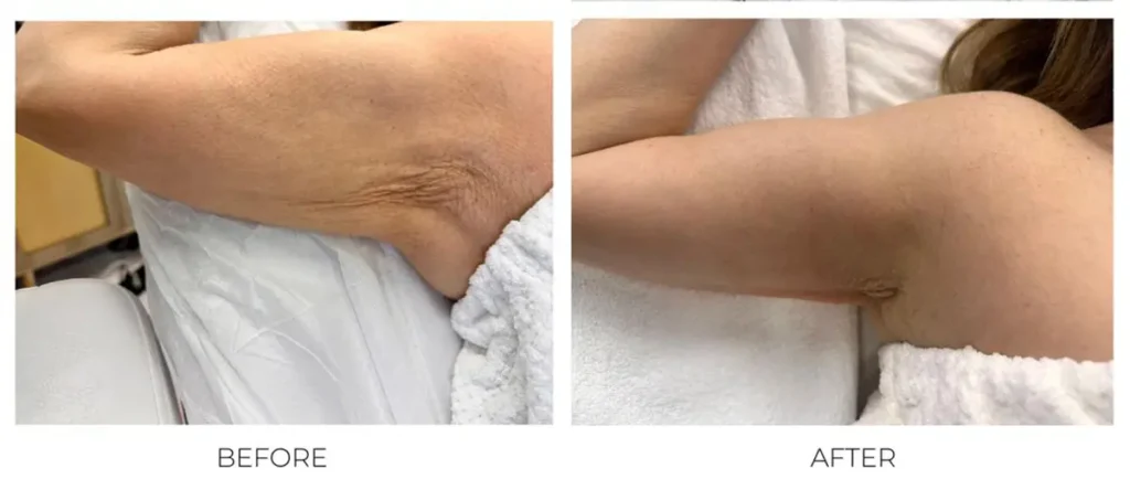 t-shape-2-arms-before-after