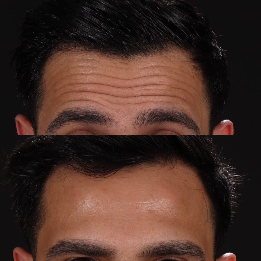 Botox Before and after