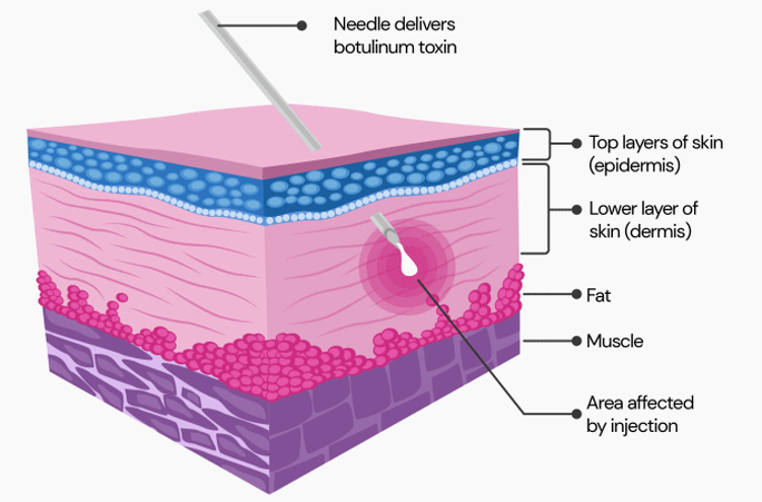 The Science Behind Botox