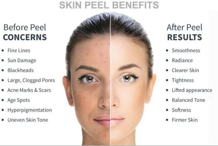 Chemical Peels Glendale