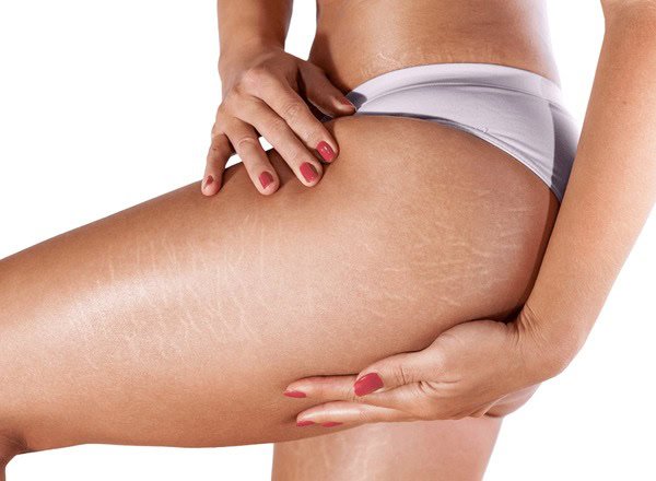 ISR treatment for stretch marks and cellulite treatment