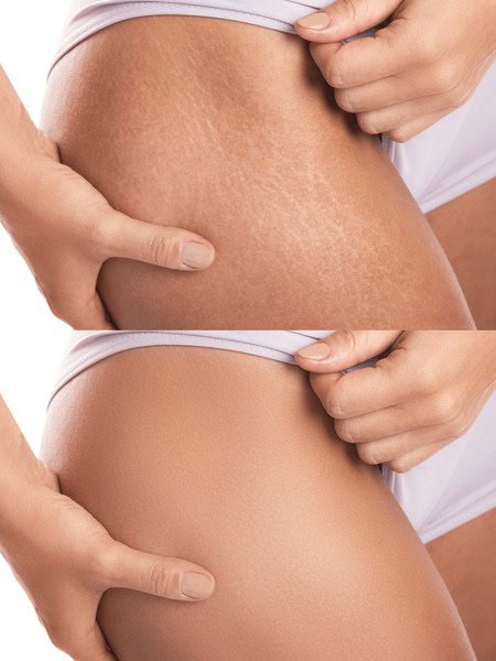 stretch mark removal by ISR treatment