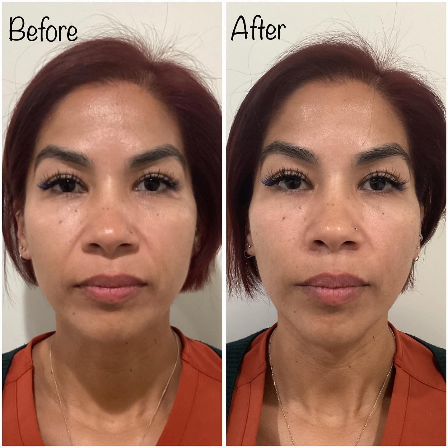 Juvéderm before and after