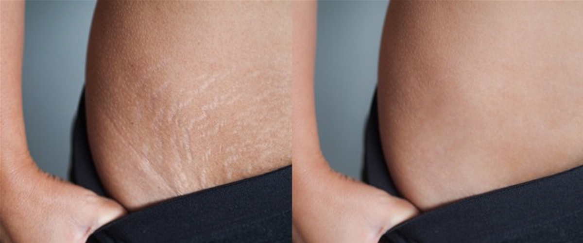 Best Stretch Mark Removal Los Angeles