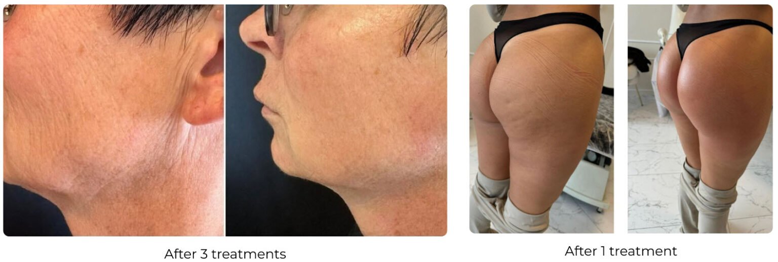 Body-sculpting-before-and-after-Glendale