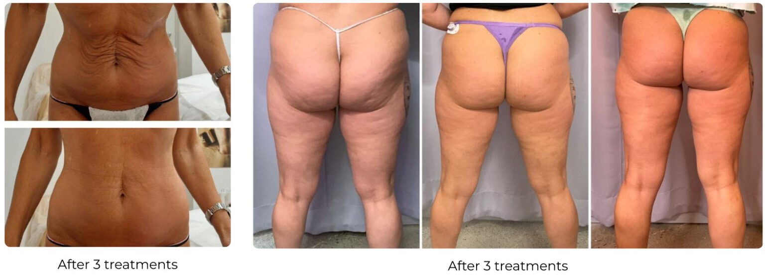 body-contouring-before-and-after-Glendale
