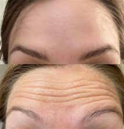 botox before and after forehead